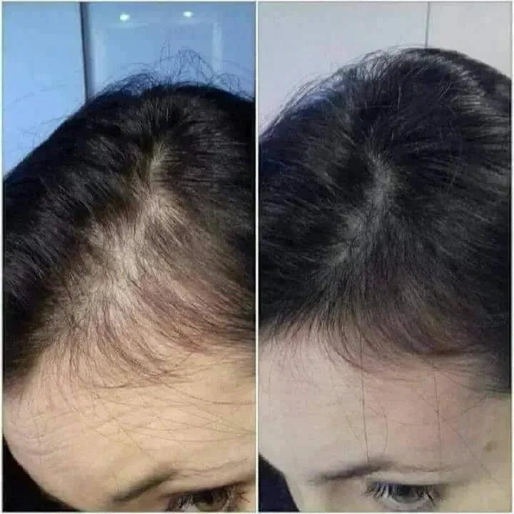 Avant et après d'une repousse rapide des cheveux, cheveux clairsemés puis épaissis.